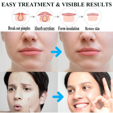 Carica l'immagine nel visualizzatore di Gallery, 300 Pezzi Pimple Patch Brufoli Cerotti Invisibili Viso Acne Patch