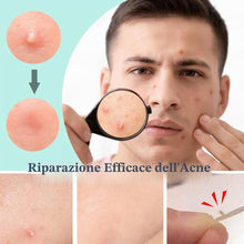 Carica l'immagine nel visualizzatore di Gallery, 300 Pezzi Pimple Patch Brufoli Cerotti Invisibili Viso Acne Patch