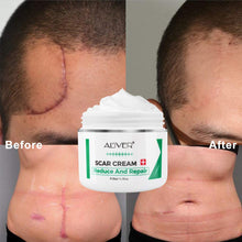 Carica l&#39;immagine nel visualizzatore di Gallery, Cicatrici Crema, Scar cream Rimuovere Cicatrici Chirurgiche, Cicatrici Acne i Smagliature Veloce Efficace Su Cheloide, Ustione, Bruciatura