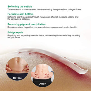 Cicatrici Crema, Scar cream Rimuovere Cicatrici Chirurgiche, Cicatrici Acne i Smagliature Veloce Efficace Su Cheloide, Ustione, Bruciatura