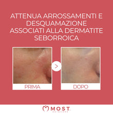 Carica l'immagine nel visualizzatore di Gallery, MOST - Crema 2s con Acido Salicilico e Zolfo, Crema Viso e Corpo Controlla Rossori e Prurito, Attenua Sfoghi da Stress, 