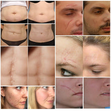 Carica l&#39;immagine nel visualizzatore di Gallery, Cicatrici Crema, Scar cream Rimuovere Cicatrici Chirurgiche, Cicatrici Acne i Smagliature Veloce Efficace Su Cheloide, Ustione, Bruciatura
