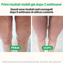 Carica l'immagine nel visualizzatore di Gallery, TESMED Cellulite: Massaggiatore Anticellulite Brevettato