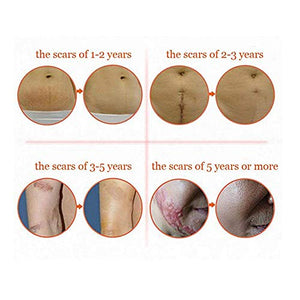 Cicatrici Crema,Scar Cream,Scar Gel,Nuovo trattamento e vecchie 50ml - Ilgrandebazar