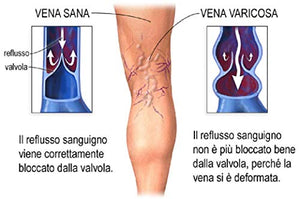 CREMA CONTRO LE VENE VARICOSE PRIMO CLASSIFICATO 2019-2020 VARICASTAN