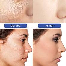 Carica l&#39;immagine nel visualizzatore di Gallery, Sapone all&#39;acne, sapone naturale fatto a mano, al viso, al...