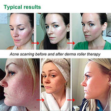 Carica l&#39;immagine nel visualizzatore di Gallery, Anmyox Derma Roller Micro aghi Kit per viso e corpo, clear-green - Ilgrandebazar