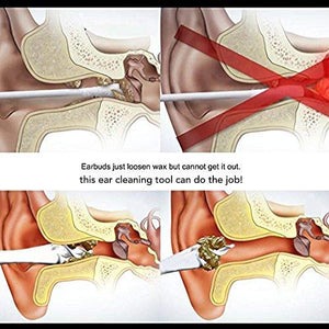 Pulizia Orecchio, Smart Ear Cleaner, Consente una Delicata e... - Ilgrandebazar