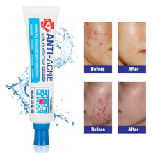 Carica l&#39;immagine nel visualizzatore di Gallery, Acne Crema, Crema Anti Acne, Cicatrici Viso 30g - Ilgrandebazar