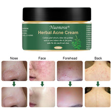 Carica l&#39;immagine nel visualizzatore di Gallery, Acne Crema, Crema Anti Acne, Cicatrici Viso... - Ilgrandebazar