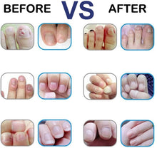 Carica l&#39;immagine nel visualizzatore di Gallery, Funghi Unghie Trattamento,Trattamento Unghie,Fungo Unghie Piedi,Antimicotico,Fungus trattamento crema piedi nail protezione anti fungine delle unghie riparazione Unguento