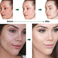 Carica l&#39;immagine nel visualizzatore di Gallery, Acne Crema, Crema Anti Acne, Cicatrici Viso... - Ilgrandebazar