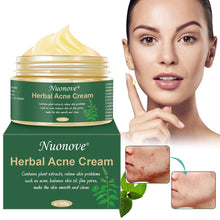 Carica l&#39;immagine nel visualizzatore di Gallery, Acne Crema, Crema Anti Acne, Cicatrici Viso... - Ilgrandebazar