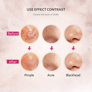Pinza Rimozione Punti Neri Naso Leva Comedoni IZUKU [GARANZIE A VITA] Blackhead Remover Kit Acciaio da 6 Strumenti Professionali con Due Estremità,togli i Punti Bianchi e le Macchie Acne dal Viso
