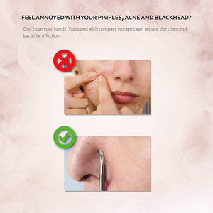 Pinza Rimozione Punti Neri Naso Leva Comedoni IZUKU [GARANZIE A VITA] Blackhead Remover Kit Acciaio da 6 Strumenti Professionali con Due Estremità,togli i Punti Bianchi e le Macchie Acne dal Viso