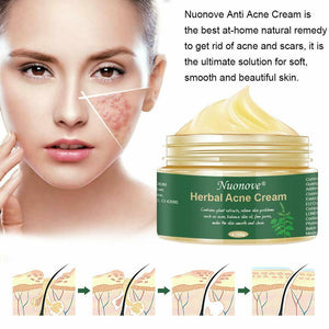 Acne Crema, Crema Anti Acne, Crema Cicatrici Acne, Crema Viso Acne, 100 g