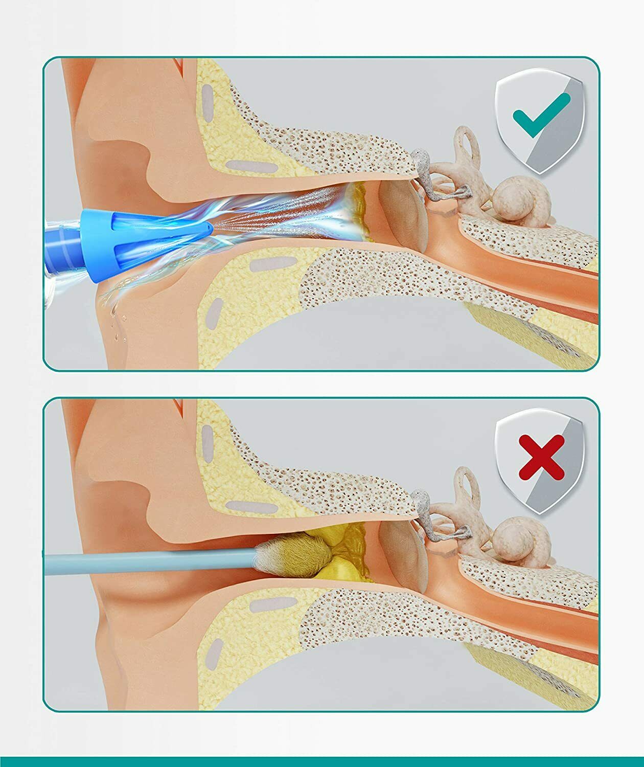 Medi Grade Kit Siringa Pulisci Orecchie – Siringa per Tappi